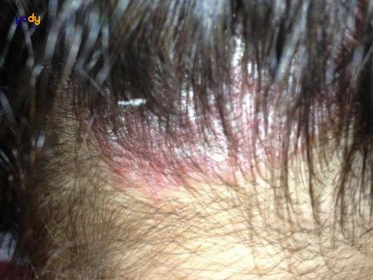 nhuộm tóc bị rát đầu