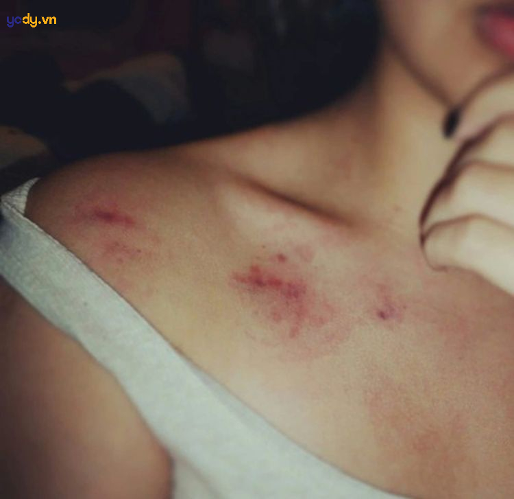 hickey là gì