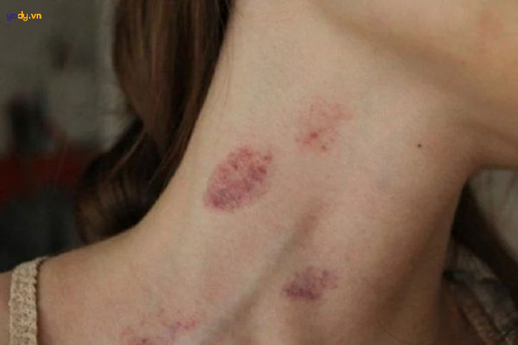 hickey là gì