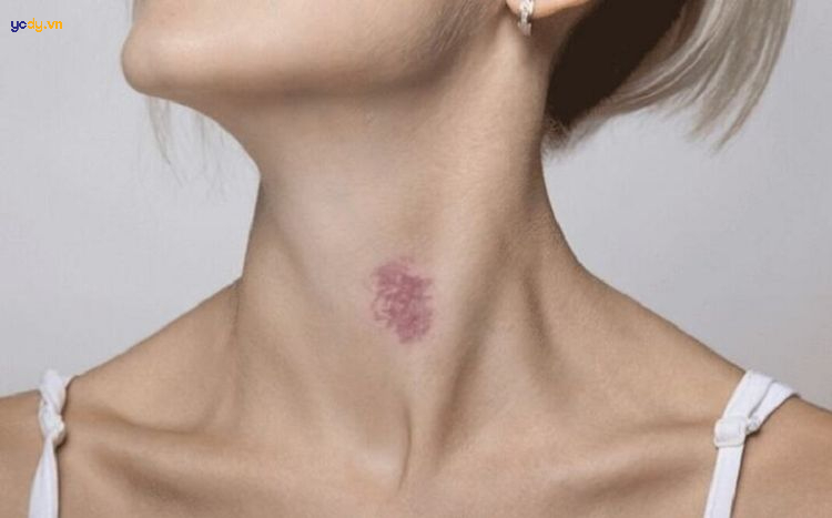hickey là gì